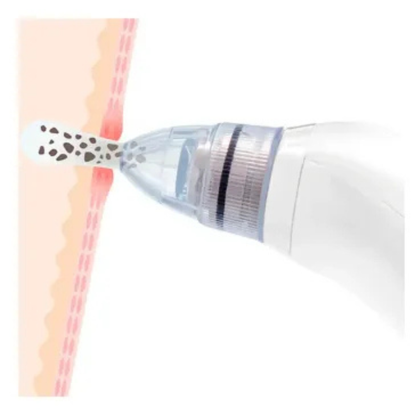 Extractor Espinillas – PorePure®